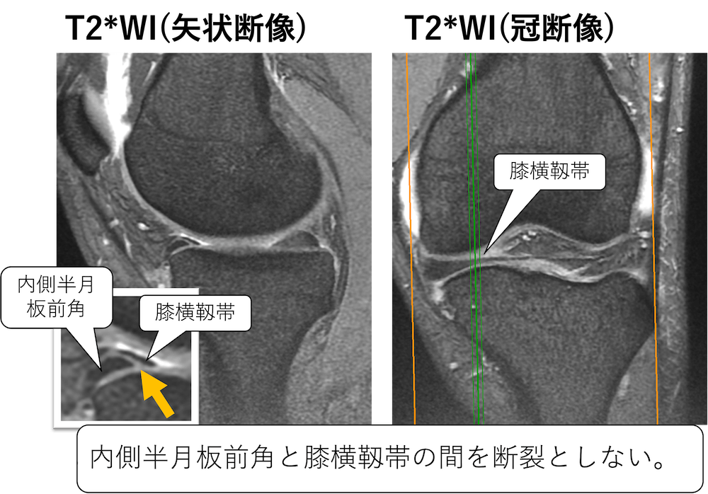 半月板断裂と誤診しないために知っておくべき3つの偽病変